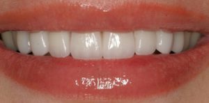 Porcelain Veneers After Restoration