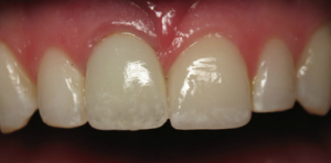 dental implant after restoration