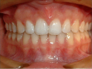 Invisalign After