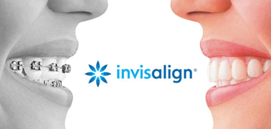 Invisalign Vs. Braces