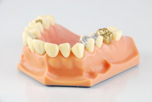 Dental Filling Model