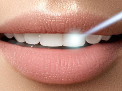 Laser Dentistry Smile