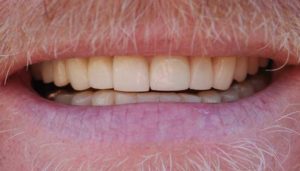 Patient 10 After Smile