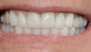 Patient 3 After Smile