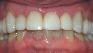 Patient 8 After Smile