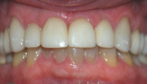 Patient 8 After Smile