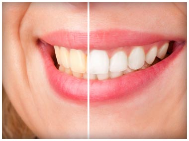 Teeth Whitening Before & After